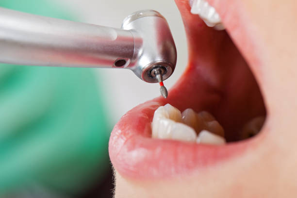 Best Emergency Tooth Extraction in Santa Rosa, TX